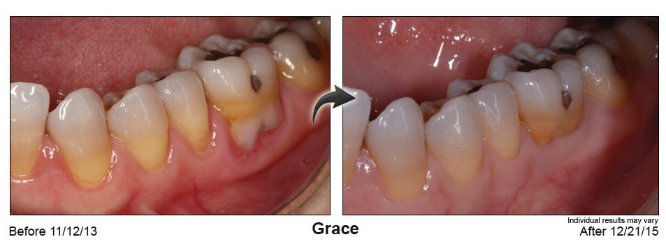 Dentist in Knoxville performs chao pinhole