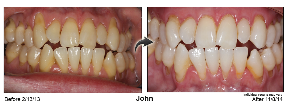 Knoxville gum recession