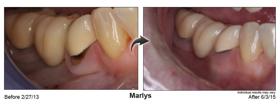 Dentist performs pinhole rejuvenation