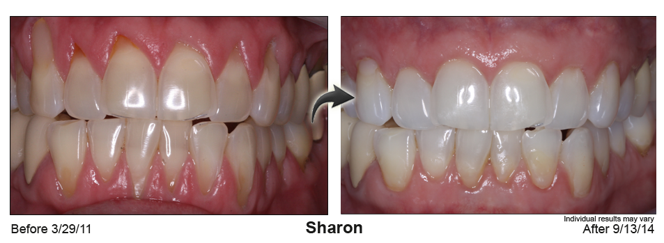 Before and After Pinhole Surgical Technique